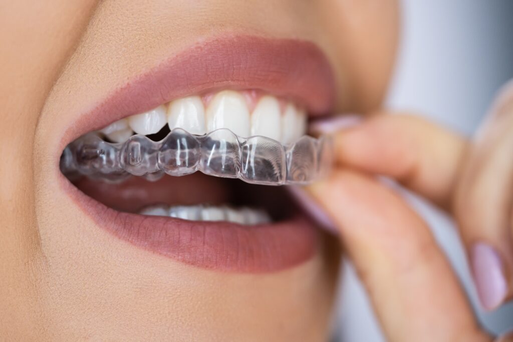 Close up of a woman inserting her top invisalign aligner into her mouth.