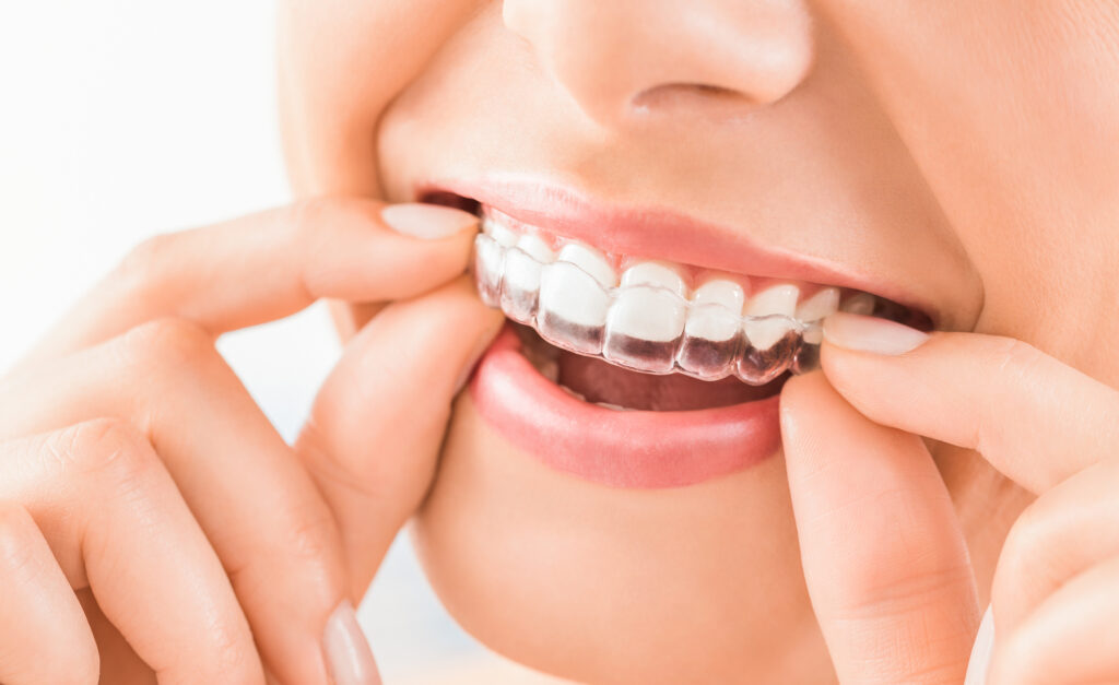 Close up of the smile of a young adult while she is inserting one of her Invisalign® aligners