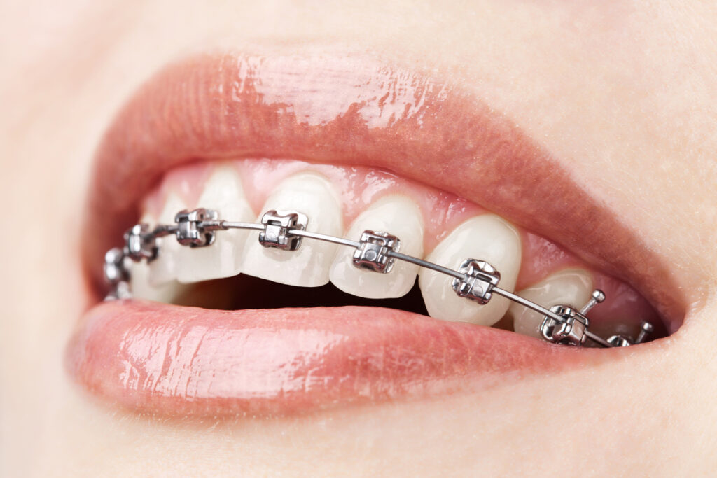 Close up of the smile of a woman with soft pink lip gloss with metal braces