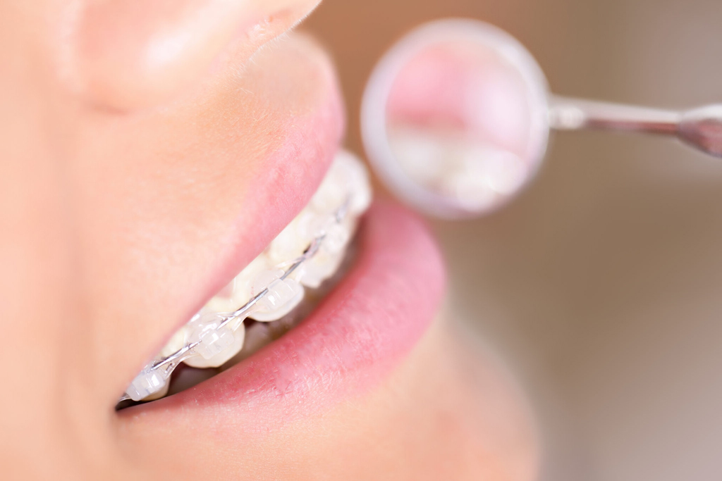 Close up of the smile of a woman with clear braces with a blue and white check mark