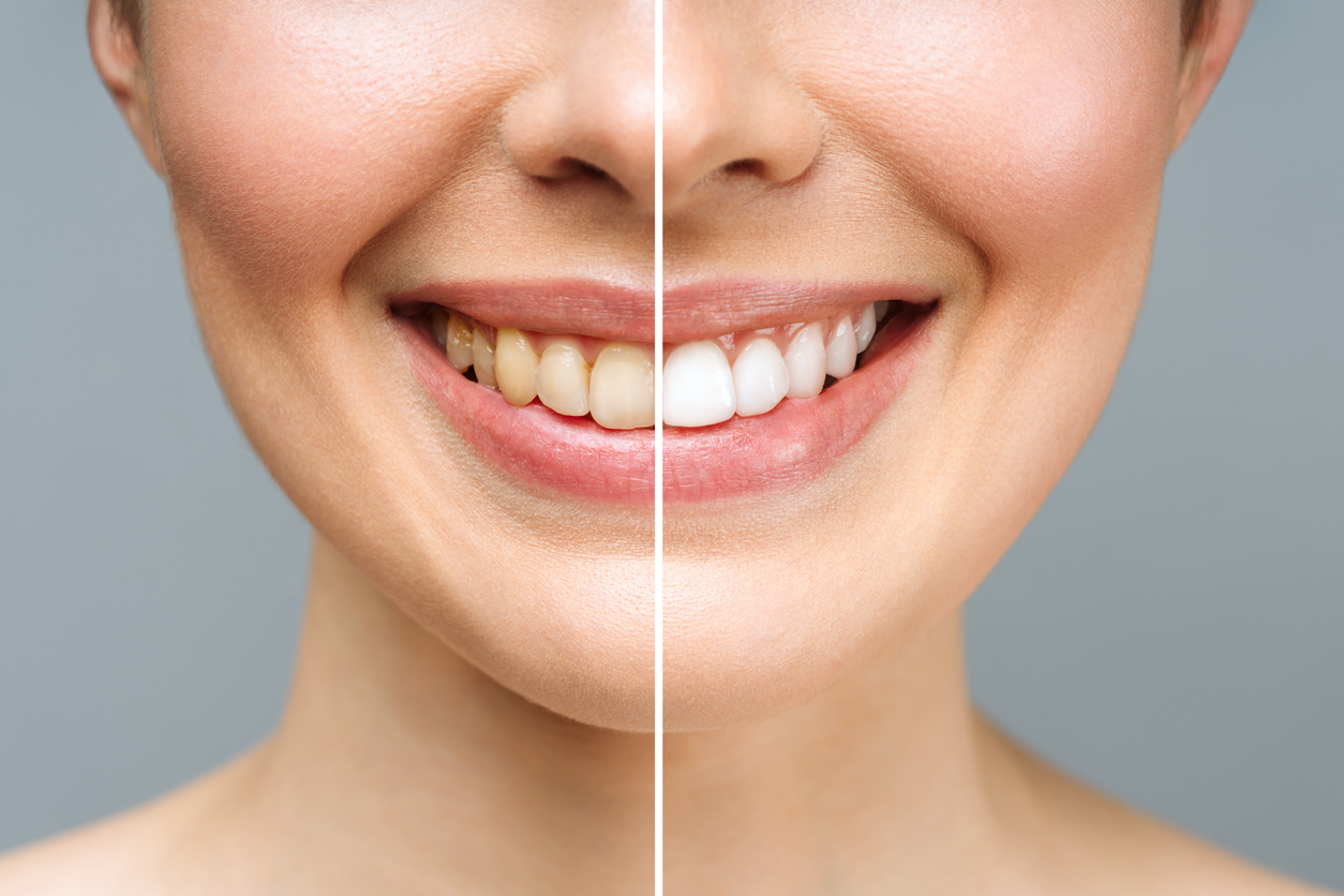 Before and after image of a woman’s smile before and after receiving professional teeth whitening